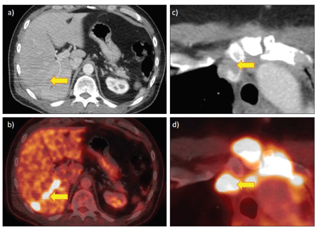 FDG PET/CT s hypermetabolickými nádorovými tromby (bez histologické verifikace, s progresí v dalším sledování):
a) a b) nádorová trombóza větve porty jako jediná manifestace metastatického postižení jater u 51letého pacienta s kolorektálním karcinomem,
c) a d) nádorový trombus v žilní náhradě u 54leté pacientky s generalizovaným thymomem