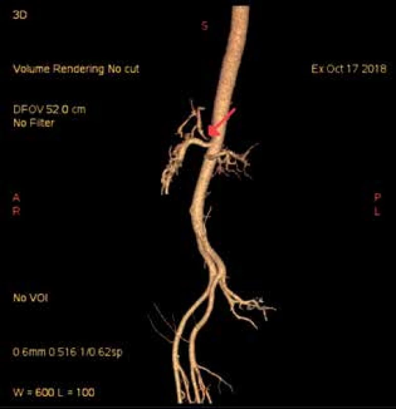 CT angiografie s nálezem stenózy kmene TC u prezentovaného pacienta (označeno šipkou)<br>
Fig. 2: CT angiography with the finding of TC stenosis in 
the presented patient (marked by the arrow)
