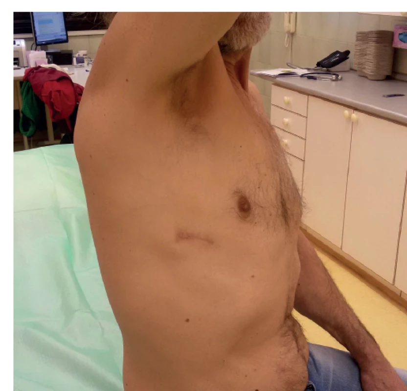 Pacient po uniportal VATS dolní lobektomii pravé
plíce<br>
Fig. 1: Patient who has had uniportal VATS right lower
lobectomy