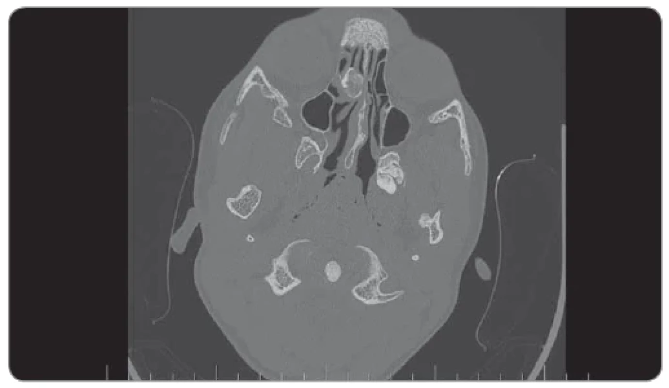 CT nález pred operáciou, axiálny rez (stenčená lamina lateralis laminae cribrformis
vpravo).