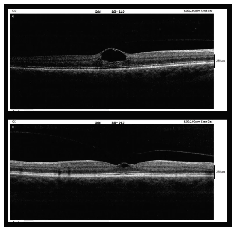 Entry OCT image (7/2017, upper – right eye, lower – left
eye)