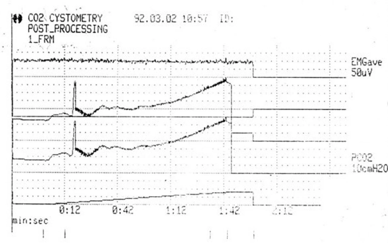 Cystometrie po selhání konzervativní léčby
(archiv autora)<br>
Fig. 1. Cystometry after conservative treatment failure