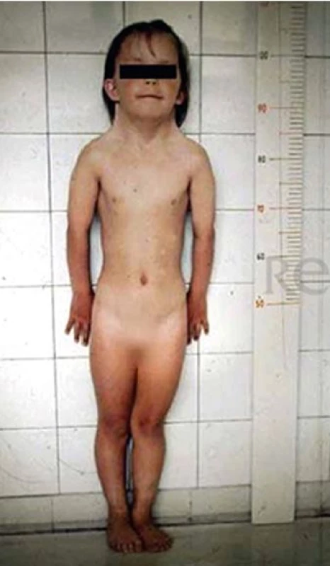 Klasické fenotypické projevy pacientky s Turnerovým
syndromem (archiv autorů).<br>
Fig. 1. The most common clinical features of Turner syndrome
(authors archive).