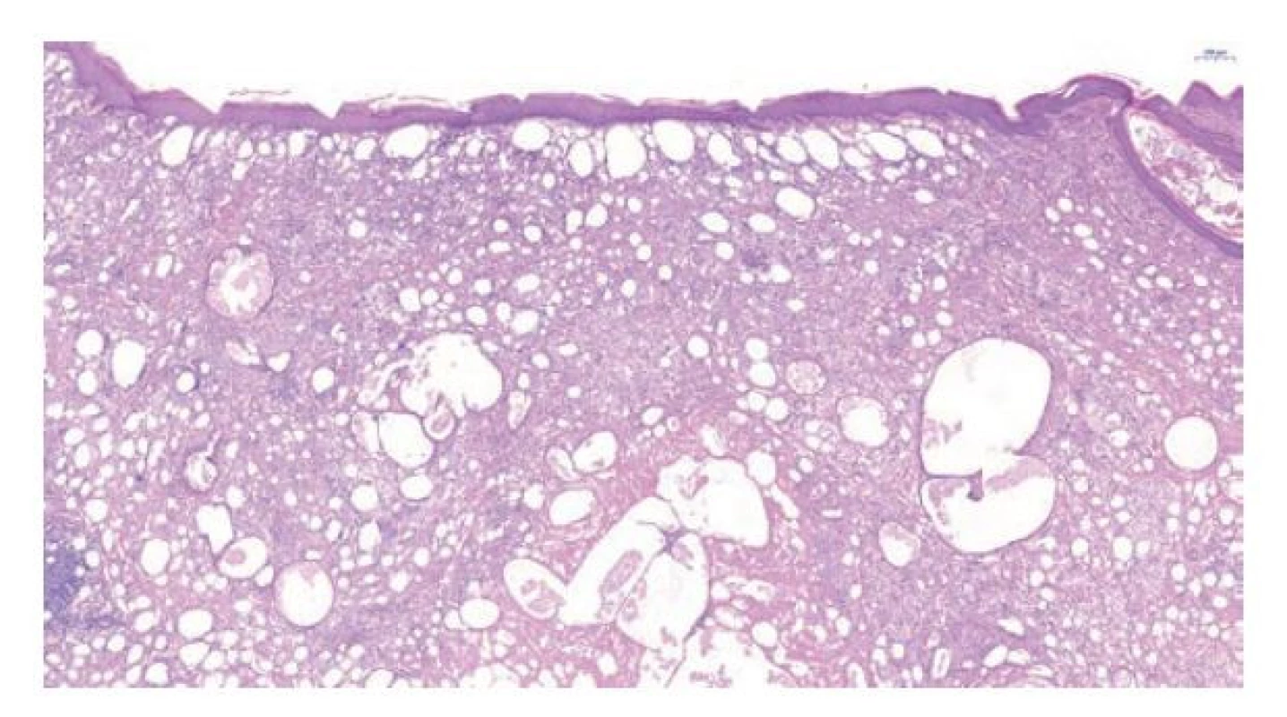 Histologie kůže penisu zobrazující množství opticky prázdných prostor
v dermis odpovídající extracelulárním kapénkám/jezírkům parafínu
vmezeřeným mezi kolagenní vlákna. Hematoxylin eosin, 4.2x.