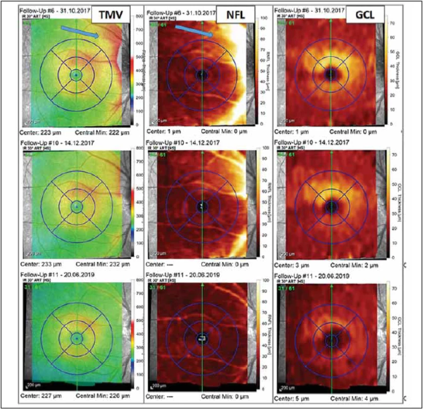 Vyšetření makuly pomocí optické koherenční tomografi e u pacientky s probíhající optickou neuritidou u neuromyelitis optica
a onemocnění jejího širšího spektra. Barevná legenda tloušťky vyšetřované vrstvy je ve sloupci vpravo u každé mapy. V prvním
sloupci jsou výsledky měření TMV, v prostředním sloupci je tloušťka vrstvy NFL a v pravém sloupci je tloušťka vrstvy GCL. U prvního
vyšetření z 31. 10. 2017 (v prvním řádku), které bylo provedeno krátce po počátku příznaků optické neuritidy, pozorujeme známky
peripapilárního edému zasahujícího do NFL a TMV (modré šipky). Vyšetření provedené s odstupem 6 týdnů (výsledky ve druhém
řádku) již ukazuje mírné tenčení vrstvy GCL a ústup peripapilárního edému. Ve třetím řádku je vyšetření provedené s odstupem od
optické neuritidy (v červnu 2019), kde můžeme pozorovat ztrátu NFL a GCL ve všech segmentech makuly a s tím spojené snížení TMV.<br>
Fig. 3. Optical coherence tomography assessment of macula in a patient with optic neuritis in neuromyelitis optica spectrum
disorders. The thickness of retinal layers is color-coded to the right of each map. The fi rst column shows the measurement of TMV, the
middle column shows the thickness of NFL, and the thickness of GCL is in the column on the right. The fi rst assessment was performed
in October 2017 shortly after the fi rst symptoms of optic neuritis and reveals peripapillary edema (blue arrows) aff ecting the NFL and
TMV (results in the fi rst row). The assessment performed six weeks later shows thinning of GCL and decrease of peripapillary edema
(results in the second row). The fi nal assessment shown was performed in June 2019 and shows loss of NFL and GCL in all macular
segments and related decrease of TMV.