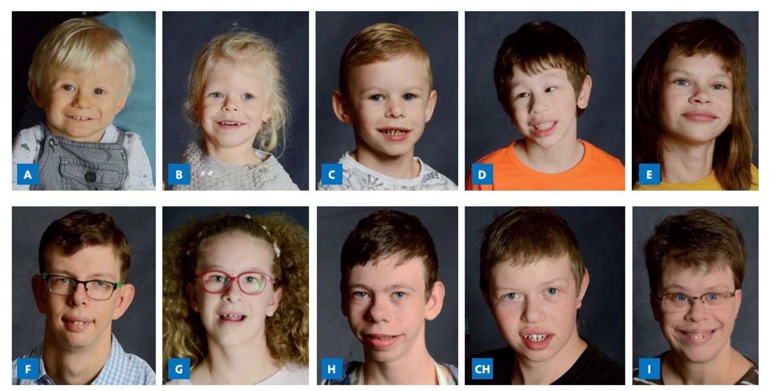 Fotografie jedinců s WBS ve věku: A – 1,5 roku; B – 4 roky; C – 5 let; D – 8 let; E – 10 let; F – 12 let; G – 13 let; H – 13,5 roku; CH – 23 let;
I – 32 let. Typické rysy „elfího“ obličeje zahrnují široké čelo, nos se sedlovitým kořenem a kulatou špičkou, boubelaté tváře, jakoby opuchlá
oční víčka, velká ústa s plnými rty, drobnými zuby a prodlouženým filtrem.