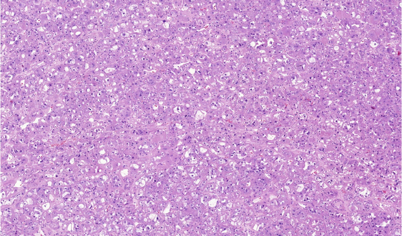 HOT (high-grade oncocytic tumor) je nádorová léze spojená s mutacemi v MTOR, TSC1, TSC2
nebo BHD genu<br>
Fig. 5. HOT (high-grade oncocytic tumor) is neoplastic lesion associated with mutations in MTOR,
TSC1, TSC2 or BHD genes