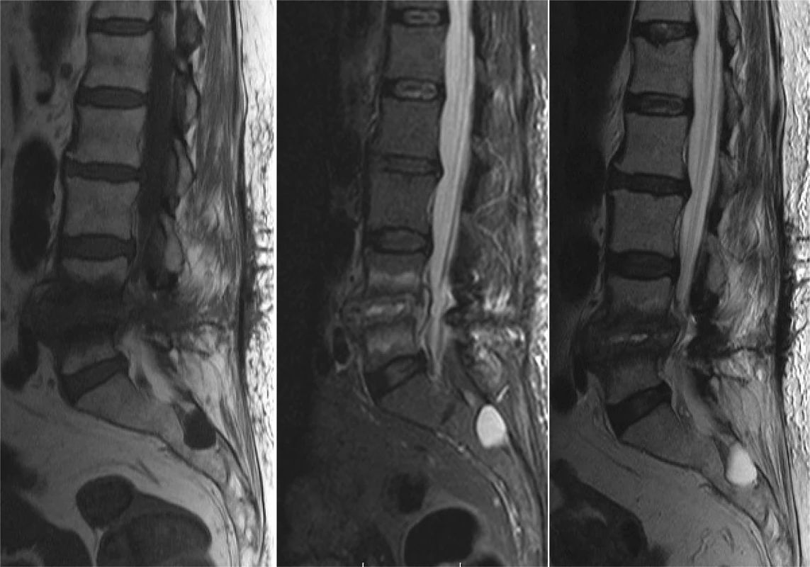 Vyšetrenie magnetickou rezonanciou pacientky so spondylodiscitídou po extirpácii medzistavcovej platničky L4/5
pre herniu − T1 váženie/ T2 váženie/ STIR (ako vedľajší nález prítomnosť Tarlovovej cysty v sakrálnej oblasti)<br>
Fig. 1: Patient after discectomy for lumbar herniated disc in level L4/5 − magnetic resonance fi ndings − T1 weight image/
T2 weight image/ STIR (sacral Tarlov cyst as an incidental fi nding)