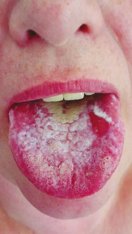 Lichenoidní stomatitida,
hypersenzitivita na kovové
dentální materiály
(z archivu autorky)<br>
Fig. 3
Lichenoid stomatitis,
hypersensitivity to dental
metal materials
(author´s archive)