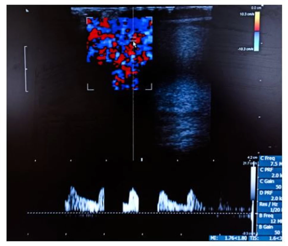 Barevné dopplerovské zobrazení pravého
varlete se zachovanou perfuzí<br>
Fig. 4. Colour Doppler evaluation of the right testis
with intact blood flow