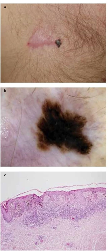  a-c. Recidiva tenkého maligního melanomu<br>
(Breslow 0,1 mm) v jizvě po předchozí chirurgické excizi