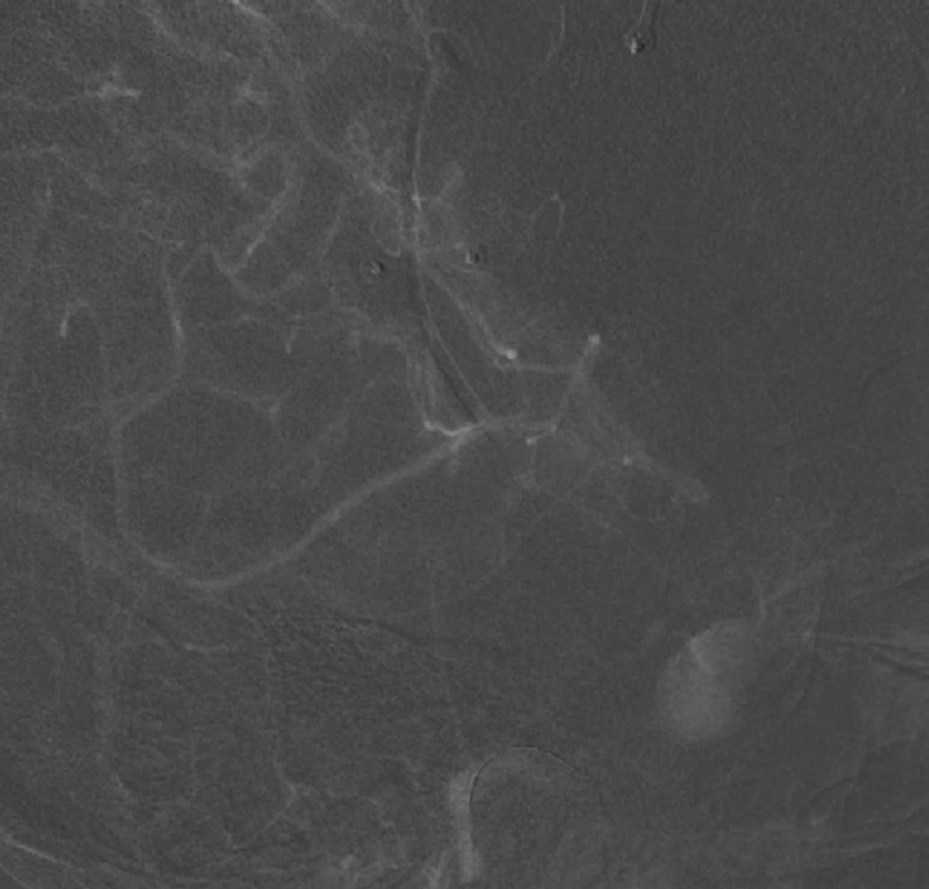 Low-flow bypass mezi větví a. temporalis superficialis a kortikální větví střední mozkové tepny v teritoriu pravé karotidy. <br>
a) peroperační foto – donorem je parietální větev a. temporalis superficialis, recipientem korová, temporálně uložená a. angularis (M4)<br>
b) průkaz průtoku bypassem na DSA <br>
c) kapilární fáze průtoku bypassem<br>
Fig. 2. Low-flow superficial temporal artery to middle cerebral artery bypass in right internal carotid artery territory. <br>
a) superficial temporal artery parietal branch as donor and cortical temporally located angular artery (M4) as recipient are in intraoperative photo <br>
b) bypass flow on DSA<br>
c) bypass flow in capillary phase