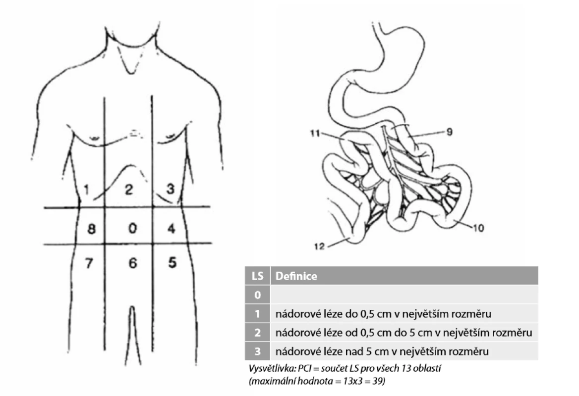 Peritonealcancer index (PCI)<br> Pro každou vyznačenou oblast (0−12) se určuje velikost přítomné léze, tzv. „lesion size“ (LS 0-3), součet LS z jednotlivých oblastí pak určuje PCI <br>Fig. 2: Peritonealcancer index (PCI) <br>Lesion size (LS 0−3) is specified for each designated area (0−12), amount of individual lesions (LS) determines PCI