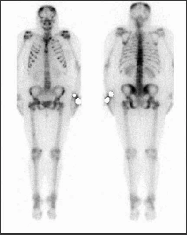 Vyšetrenie zobrazovacími metódami:
scintigrafia – skeletálne metastázy. Archív Onkologického
ústavu sv. Alžbety, s.r.o., Bratislava