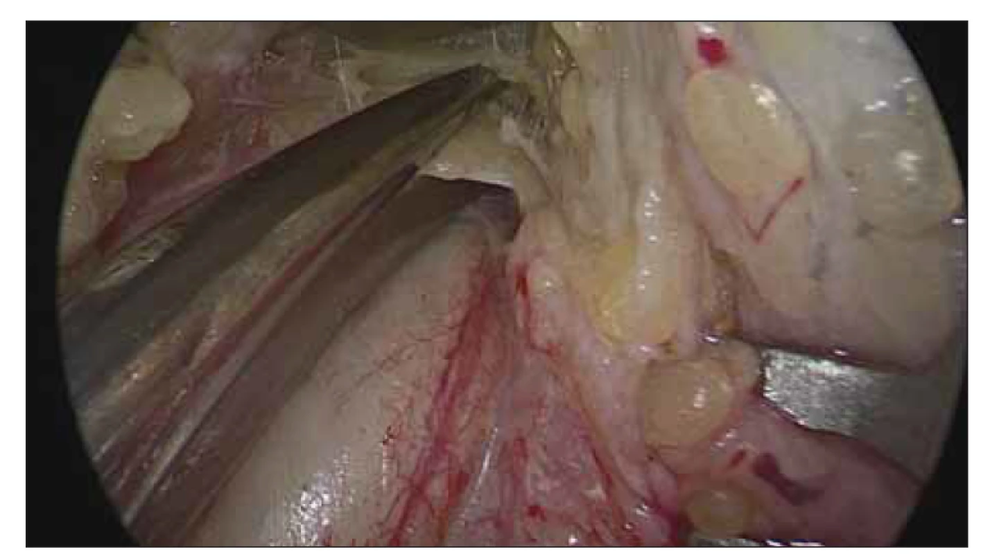Vazivové pruhy kryjící nervus ulnaris jsou protnuty.<br>
Fig. 4. Fibrotic bands covering the ulnar nerve are divided.