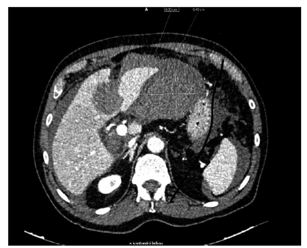 Axiální řez CT břicha s kontrastní látkou ve venózní
fázi − hemoperitoneum v okolí jater a sleziny, hematom
v oblasti levého laloku jater a hydropický žlučník
s nehomogenním obsahem<br>
Fig. 2: Axial projection of CT of the abdomen with a contrast
agent in the venous phase − hemoperitoneum
around the liver and spleen, hematoma in the area of the
left lobe of the liver and hydropic gallbladder with inhomogeneous
content