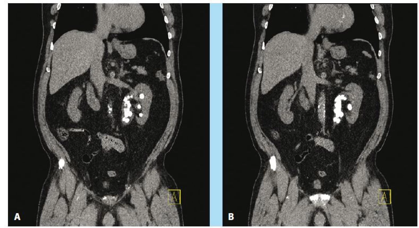 Stav primárne neriešiteľný bez nasadenia kombinovaného prístupu<br>
Fig. 4. Multiple urolithiasis (aprox. 18 high density concremets), PUJ-Syndrom – Laparoscopic surgery indicated as
first step in combinated therapy