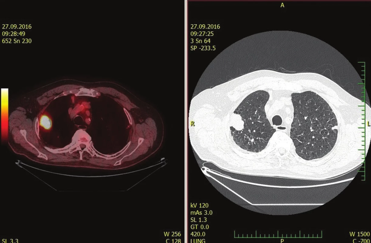 Suspektní metastáza/karcinom na PET/CT trupu<br>
Fig. 4: Suspected meta/carcinoma in PET/CT of the trunk