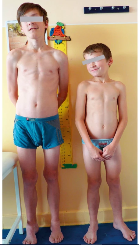 Pacienti s MPS I Scheie syndrómom.<br>
Fig. 1. Patients with MPS I Scheie syndrome.