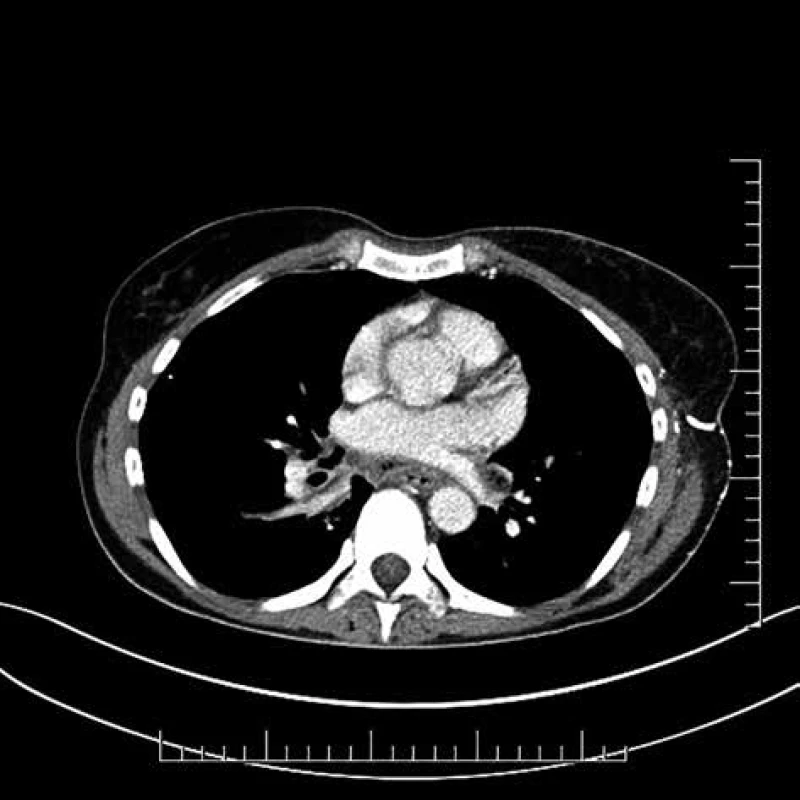 Descendentná nekrotizujúca mediastinitída <br>Fig. 2: Descendent necrotising mediastinitis