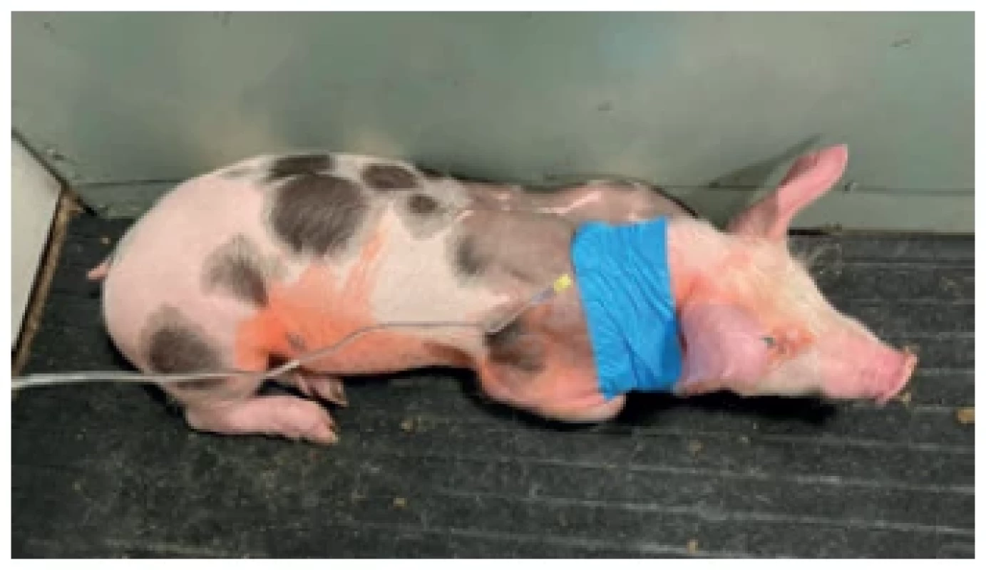 Použití portu k infuzní terapii v časném pooperačním
období <br> 
Fig. 2. Vascular access port use for infusion in the early
postoperative period