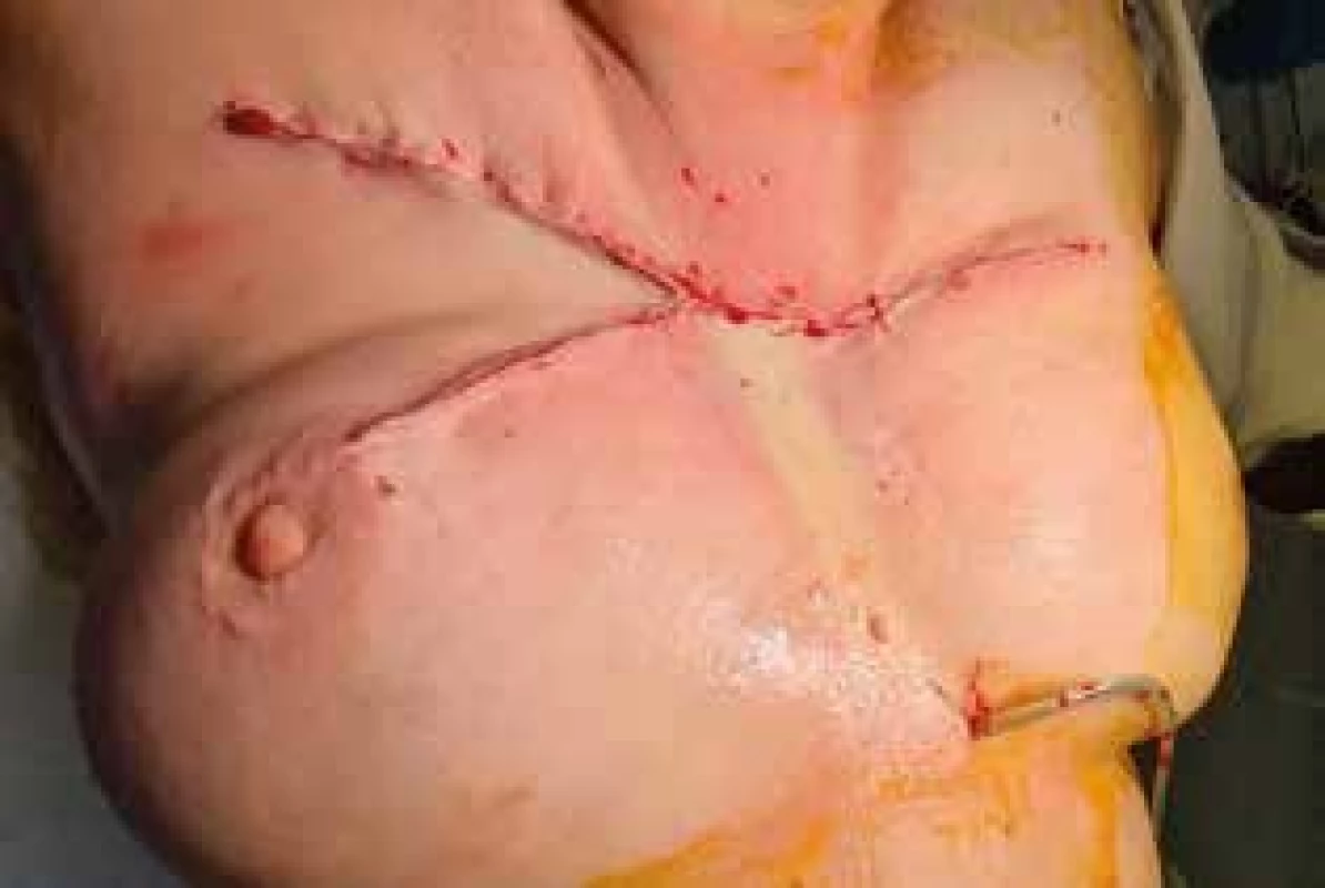Stav po operaci <br>
Fig. 4: Postoperative findings