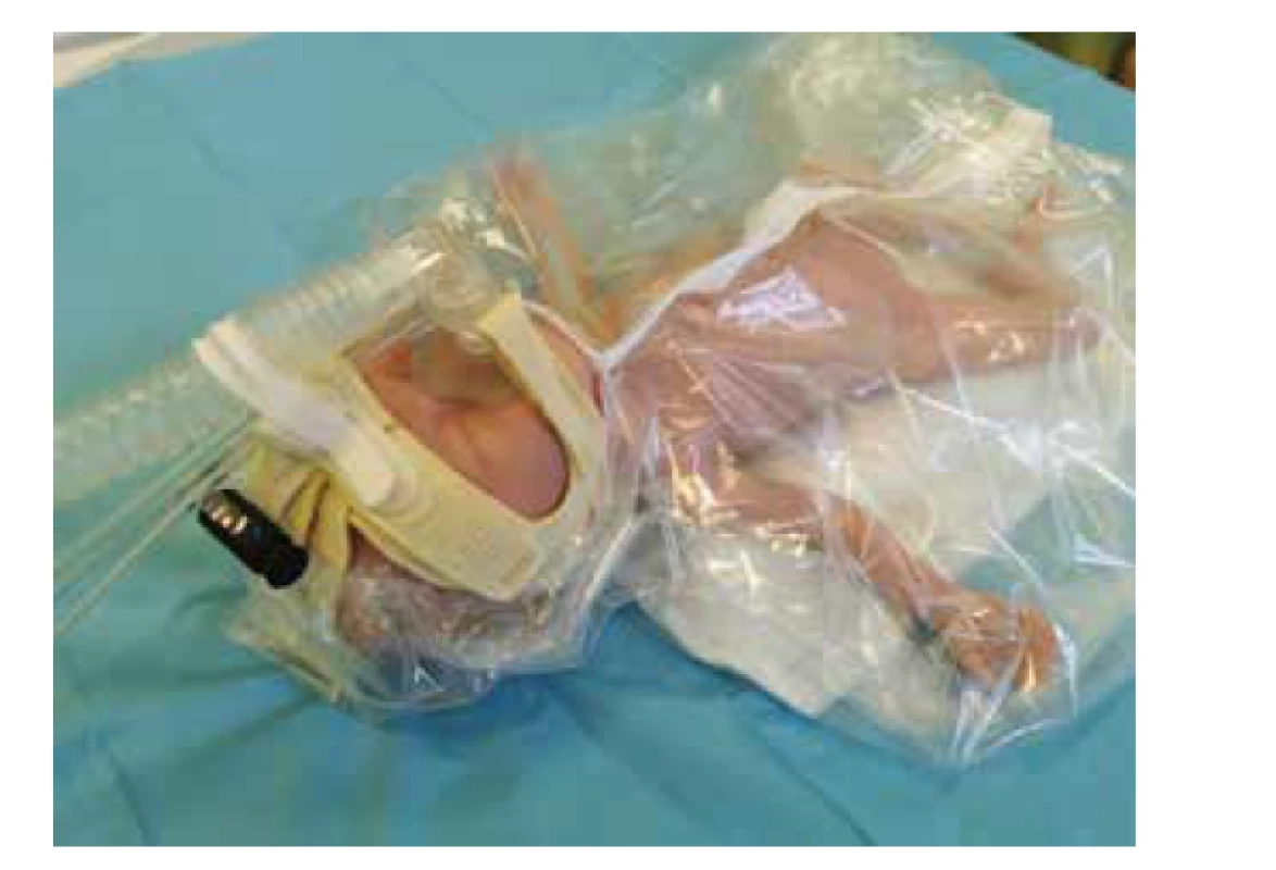 CPAP aplikovaný přes nosní masku.<br>
Fig. 6. CPAP, nasal mask.