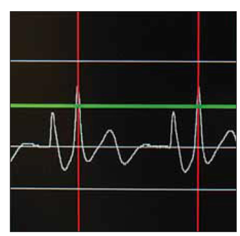 Intravazální EKG, dosažení
maximální amplitudy vlny P při
kavoatriální poloze konce katetru.
