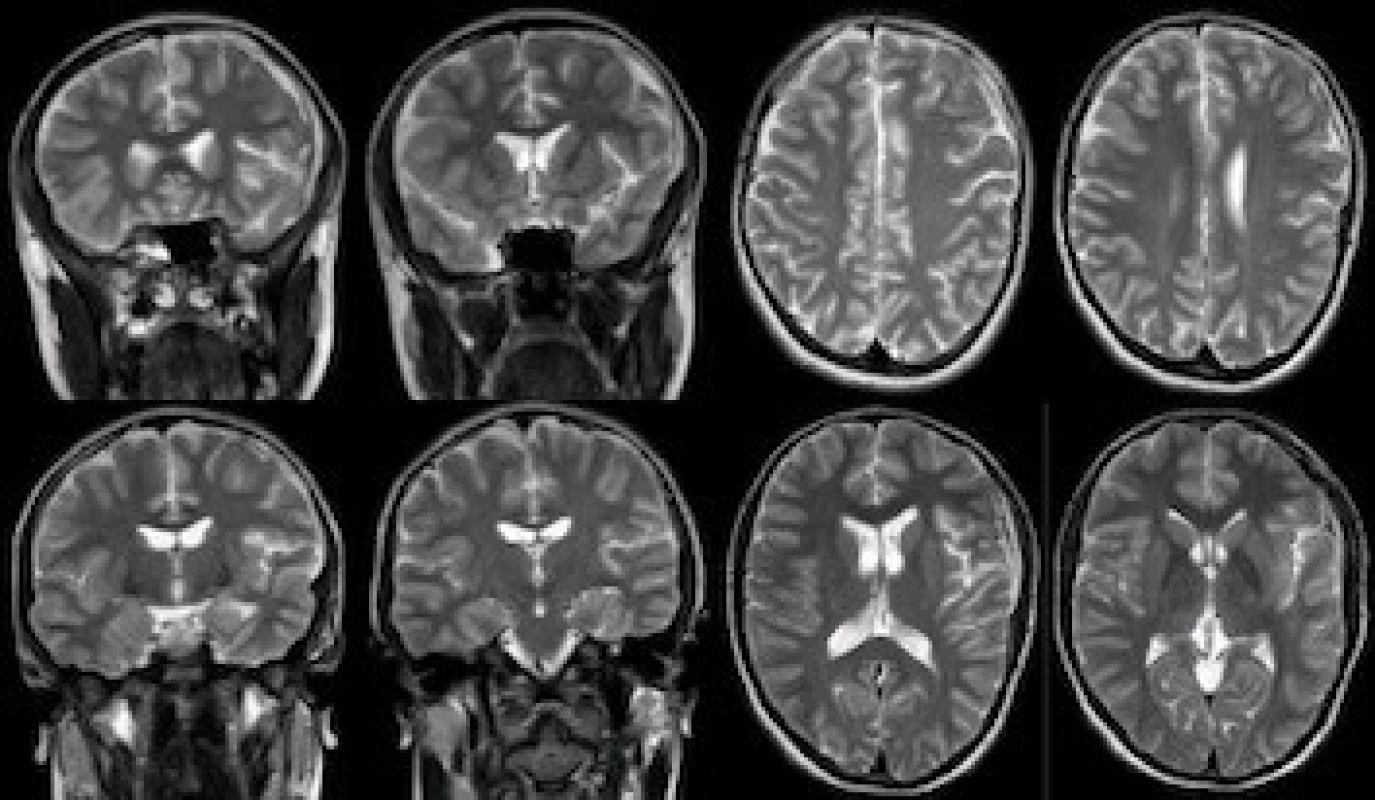Near-total resolution of the arachnoid cyst on a 6-month follow-up MRI.
Obr. 4. Významná regrese arachnoideální cysty zobrazené na kontrolní MR po 6 měsících.
