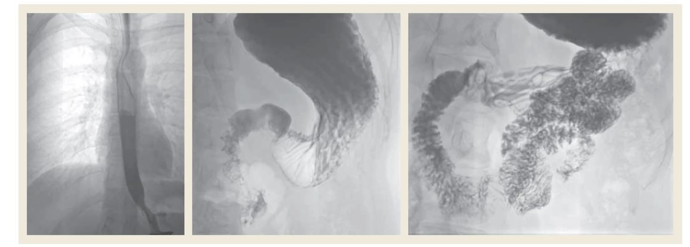 Skiaskopické vyšetření pasáže horní částí GIT (snímky použity s dovolením ZRIR IKEM).<br>
Fig. 1. Fluoroscopy examination of the passage of the upper part of the GIT (images used with the permission of ZRIR IKEM).