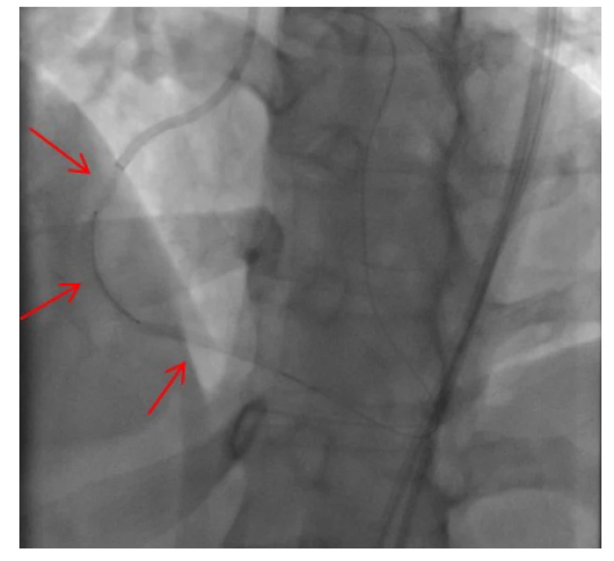 Implantace lékového koronárního stentu do střední části pravé
věnčité tepny, šipky ukazují pozici tří postupně implantovaných stentů