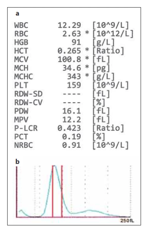 (a) Hodnoty krevního obrazu
z analyzátoru Sysmex XN-10 v případě,
kdy analyzátor vydal hlášení
o přítomnosti dimorfní populace RBC;
hodnoty červeného krevního obrazu
jsou označeny hvězdičkou * – znakem
snížené spolehlivosti. (b) Histogram
RBC – analyzátor vydal hlášení o abnormální
distribuci RBC a dimorfní
populaci erytrocytů; červenými čarami
jsou vyznačeny referenční meze
MCV (zdroj: laboratoř IV. IHK).<br>
RBC – erytrocyty, MCV – střední objem
erytrocytů