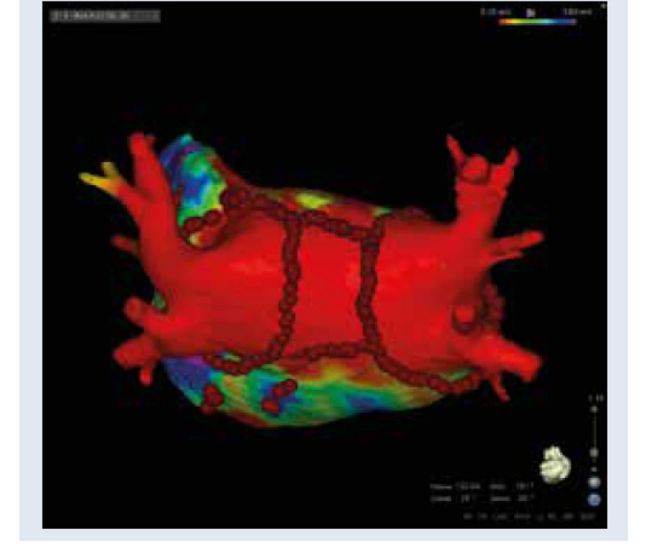 Substrátová modifikácia ĽP katétrovou
abláciou (pohľad zozadu). Elektroanatomická
mapa ĽP (vysoko denzitné mapovanie,
CARTO 3) po rozsiahlej substrátovej modifikácii
(identický pacient s obr. 1 a obr. 2).
Realizovaná široká antrálna izolácia pľúcnych
žíl, izolácia remodelovanej zadnej steny ĽP
(box), fokálna ablácia v miestach abnormálnej
fokálnej elektrickej aktivity. Ablačné body zobrazené
tmavočervenou. Svetločervená farba
znázorňuje absenciu elektrických potenciálov
v pľúcnych žilách a v izolovanej zadnej stene
ĽP po katétrovej ablácii (< 0,1mV).<br>
Archív autora