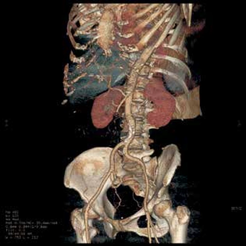 CT 3D rekonstrukce, omezený průtok AMS<br>
Fig. 2: 3D reconstruction of CT Images, reduced flow of
AMS