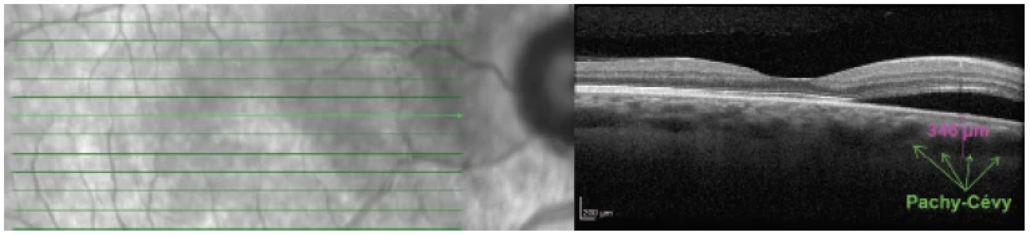 Lineární horizontální transfoveolární OCT sken pravého oka: peripapilární pachychoroidní syndrom, ablace neuroretiny
v peripapilární zóně