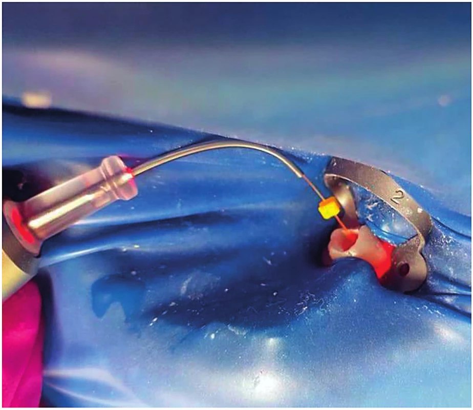 Endodoncia za pomoci diodového lasera vlnová dĺžka, infračervená dióda 970 nm (autor snímky:
Kyjovská Čičváková)