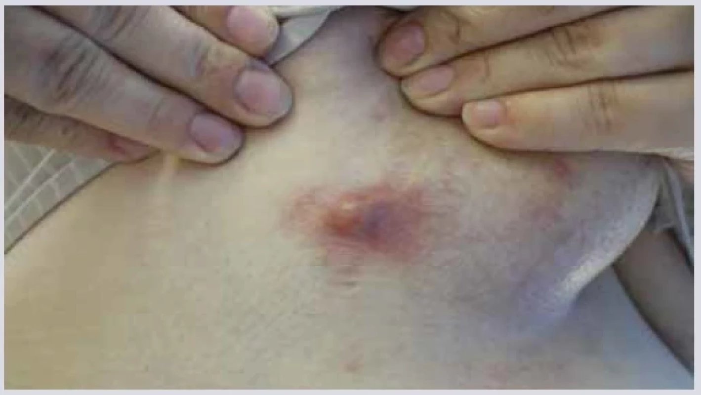 Absces. <br> 
Fig. 3. Abscess.