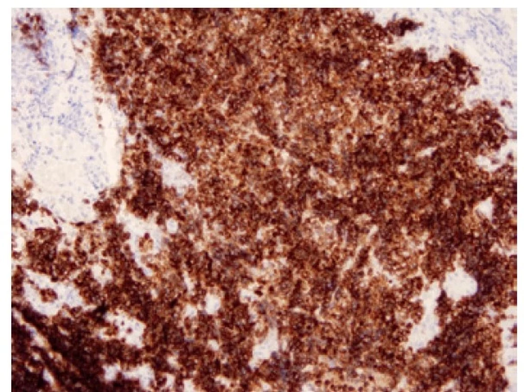 Malobuněčný karcinom pozitivní v imunohistochemickém průkazu
DLL3. 100x.