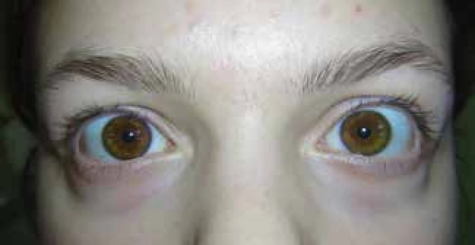 Normalisation of pupil width at follow-up examination
of patient one day later