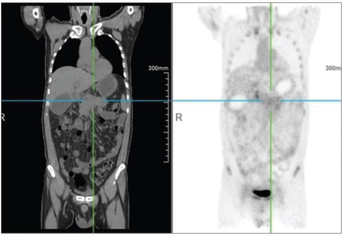 CT a 68Ga-DOTA-NT- 20.3 PET pacienta 1 s PDAC vykazuje jen mírně zvýšenou akumulaci radiofarmaka v tumoru (Department of Nuclear Medicine, Nanjing First Hospital, Nanjing, Medical University, Nanjing, China).