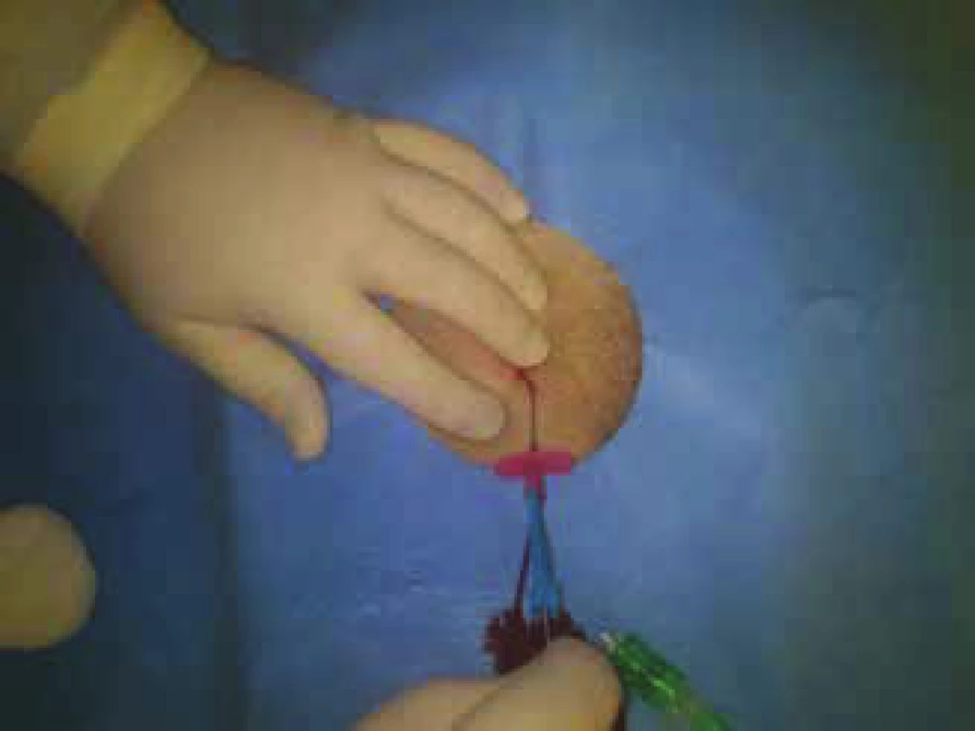 Insertion of sheath into arteria femoralis communis
(AFC) I. dx