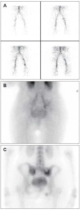 Třífázová scintigrafie skeletu zaměřená na oblasti pánve
a beder, zadní projekce. A – fáze krevního průtoku oblastí, bez signifikantní
abnormalit. B – fáze tkáňového prokrvení, velmi mírně
zvýšené tkáňové prokrvení v oblasti pravé části pánve, marker na
pravé straně. C – kostní fáze, zvýšená kostní přestavba v sakrální
a sedací kosti.