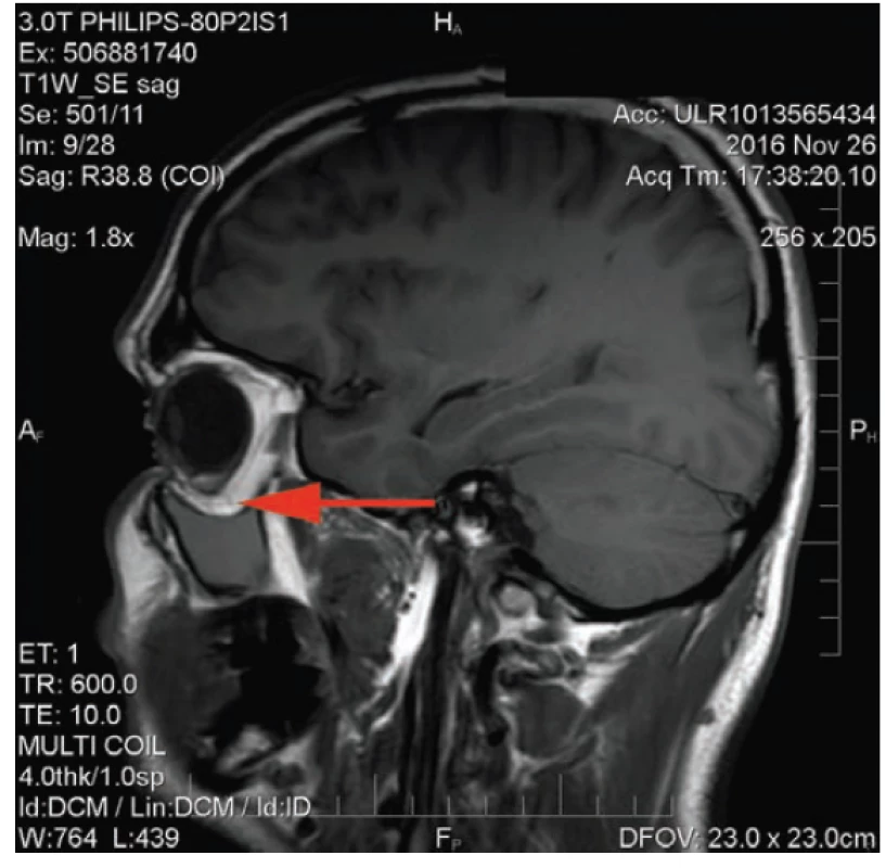 MR scan: orbital floor displaced inferiorly
