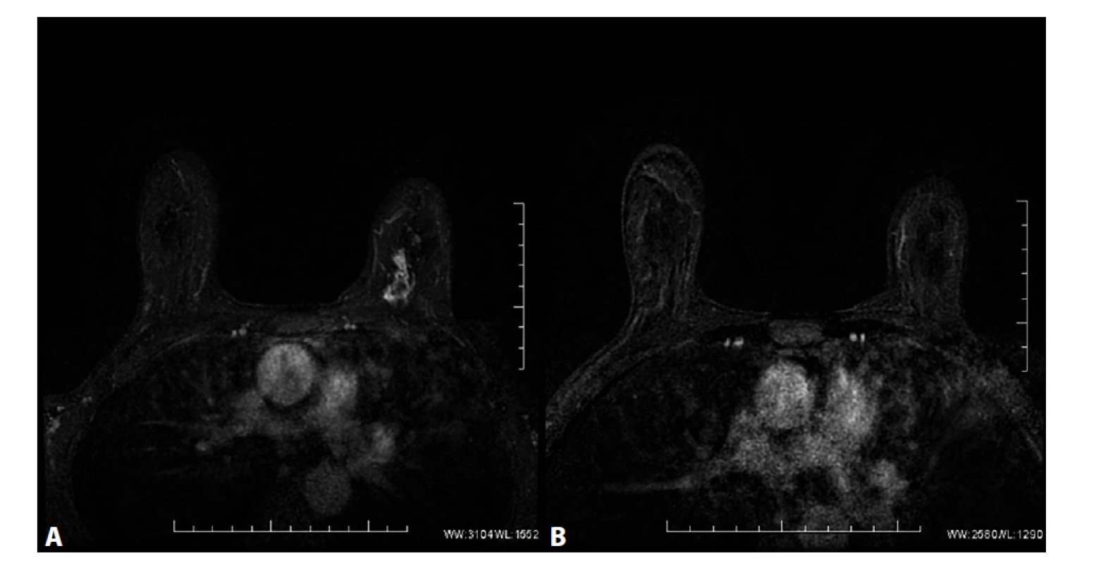 MRM. T1FS ax, kontrastní studie VIBRANT, 2. postkontrastní sekvence, subtrakce<br>
A) Před NCHT. Patologické sycení ložiskového typu v HVK l. sin odpovídající karcinomu. V centrálních oddílech tumoru
výpadek sycení odpovídající nekrotickým změnám ca. B) Po NCHT. Absence sycení po NCHT, bez průkazu rezidua
tumoru, rCR.<br>
Fig. 5: MRI, T1FS ax, contrast study VIBRANT, 2. postcontrast sequence, subtraction<br>
A) Before NCT. Pathological mass enhancement in the UIQ of left breast corresponding to carcinoma. Absence of enhancement
in the central part of the tumour corresponds to necrotic changes. B) After NCT. Absence of enhancement
after NCT, without detection of residual tumour, rCR.