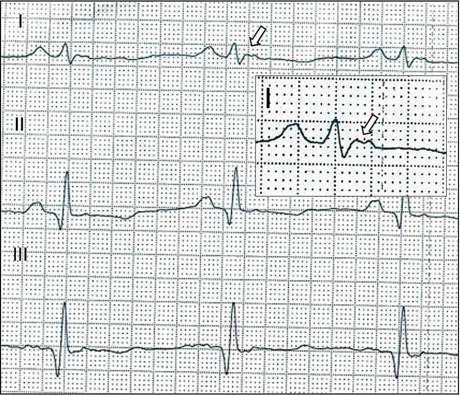  Arytmogenní kardiomyopatie – EKG. Vlna Epsilon odrážející opožděnou aktivaci pravé komory ve standardním svodu I (šipka).