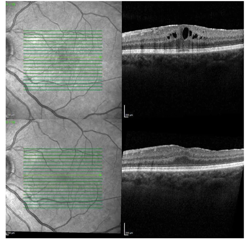 OCT B scan u pacientky s epiretinální membránou a cystickými změnami v neuretině před operací (horní část snímku) a po
operaci (dolní část snímku)