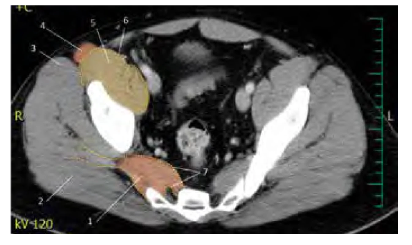 Schéma iliopsoatické fascie a fascie m. piriformis. 1. m. piriformis,
2. m. gluteus maximus, 3. m. tensor fascia late, 4. m. sartorius, 5. m. iliopsoas,
6. iliopsoatická fascie, 7. fascie m. piriformis