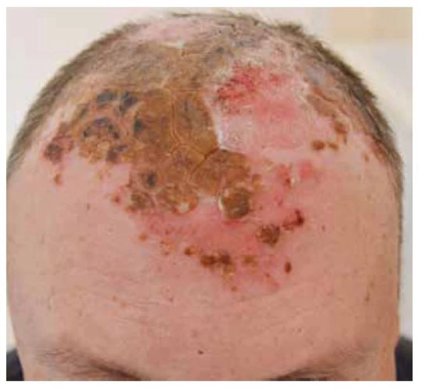 Pemphigus vulgaris, postižení kštice
