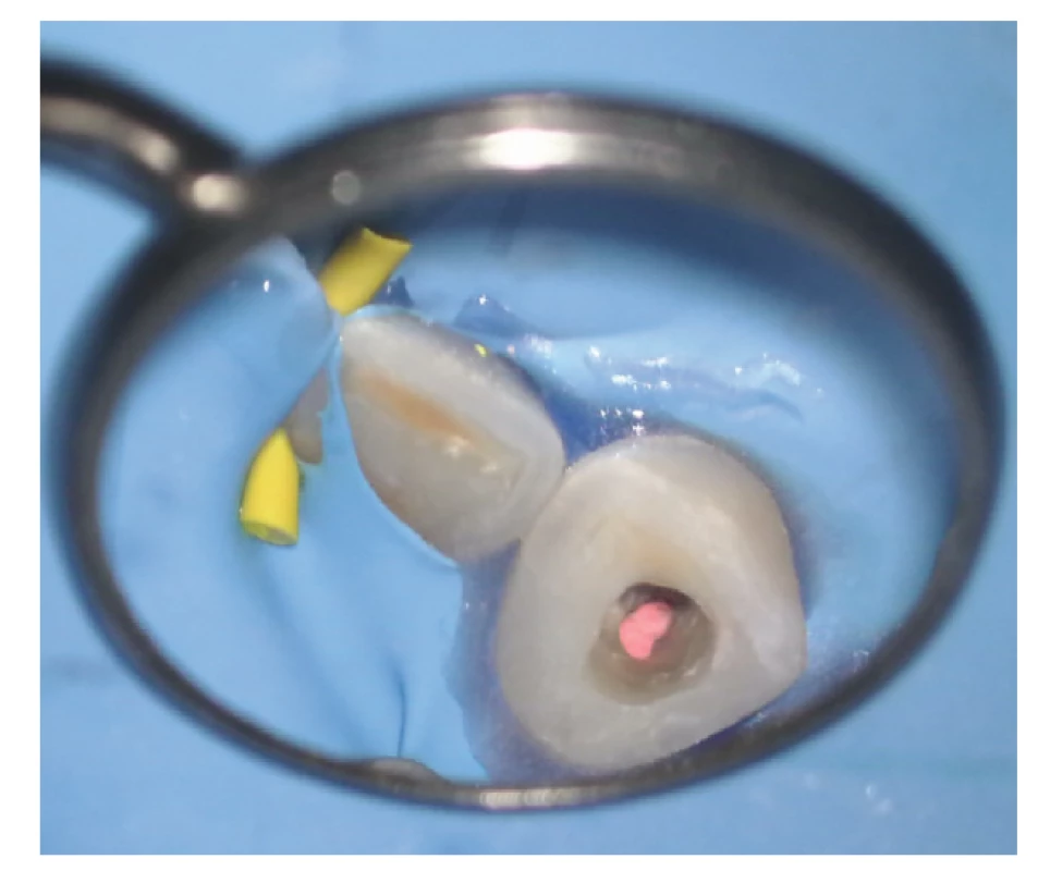 Situace po zkrácení gutaperčového čepu a vertikální kondenzaci, pohled na spodinu dřenové dutiny po vyčištění <br>
Fig. 9 Situation after shortening the gutta-percha cone with an ultrasonic tip without cooling and vertical cold condensation, view of the pulp chamber floor after cleaning