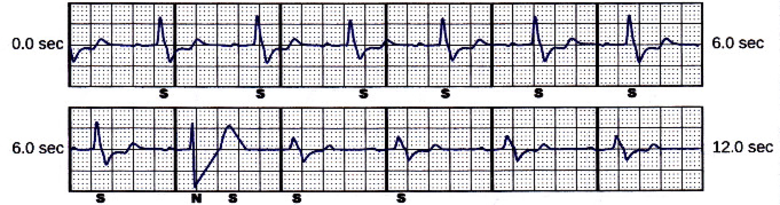 Secondary sensing vector snapshot. Beat
marked “N” is noise.